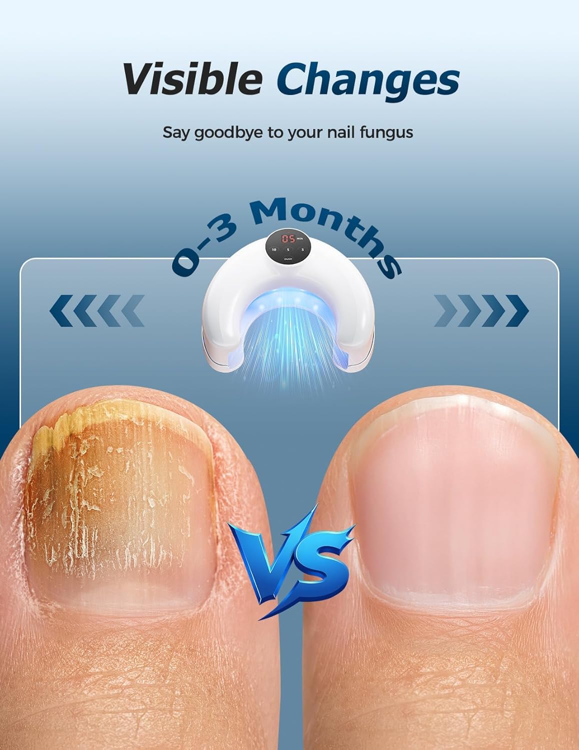 Rechargeable Nail Fungus Laser Device, Nail Laser Treatment Device for Damaged and Discolored Nails, Effective Home Use Solution for Multiple Toenails & Fingernails