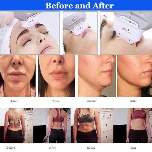Smart HIFU Beauty Device with 7 Exchangeable Tips,Face Lifting Body Shape Treatment Machine,Collagen Booster,Targets Jawline,Wrinkles Cellulite,Home & Salon Use