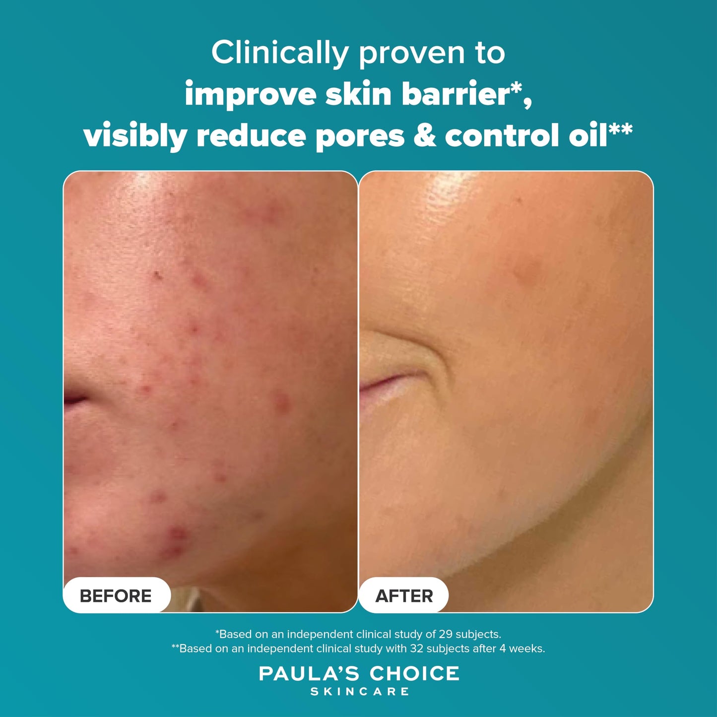 Paula's Choice SKIN PERFECTING 2% BHA Liquid Exfoliant - Face Exfoliating Peel Fights Blackheads & Enlarged Pores - for a Healthy Glow - with Salicylic Acid - Combination & Oily Skin - 118 ml