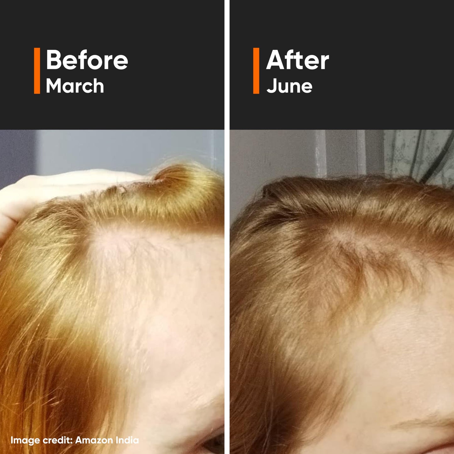 Minimalist Hair Density Serum 18% | Hair Growth Serum| Procapil, Capixyl, Redensyl, Anagain & Baicapil | Hair Fall Control & Hair Thickening | Women & Men | 30 ml